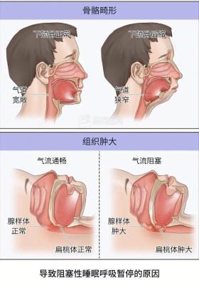 这病会让人越长越丑、还影响智力！瑞金医院近期频繁接诊，紧急提醒